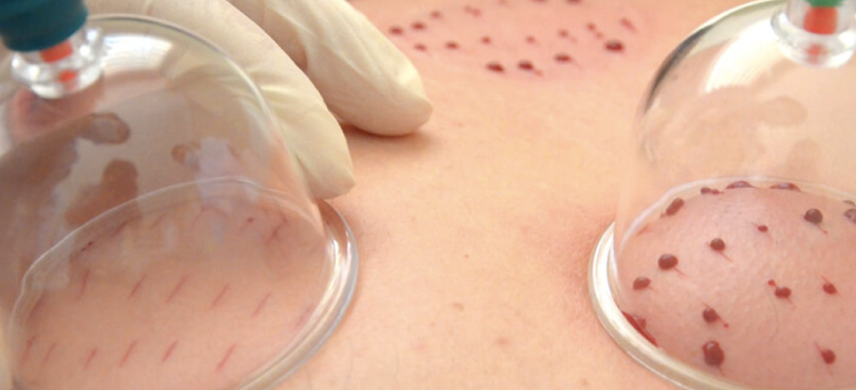 Kupa Terapisi (Hacamat)